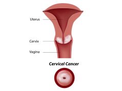 Nigeria Records 12,000 Cervical Cancer Cases, 8,000 Deaths Yearly Cervical Cancer