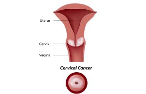Nigeria Records 12,000 Cervical Cancer Cases, 8,000 Deaths Yearly Cervical Cancer