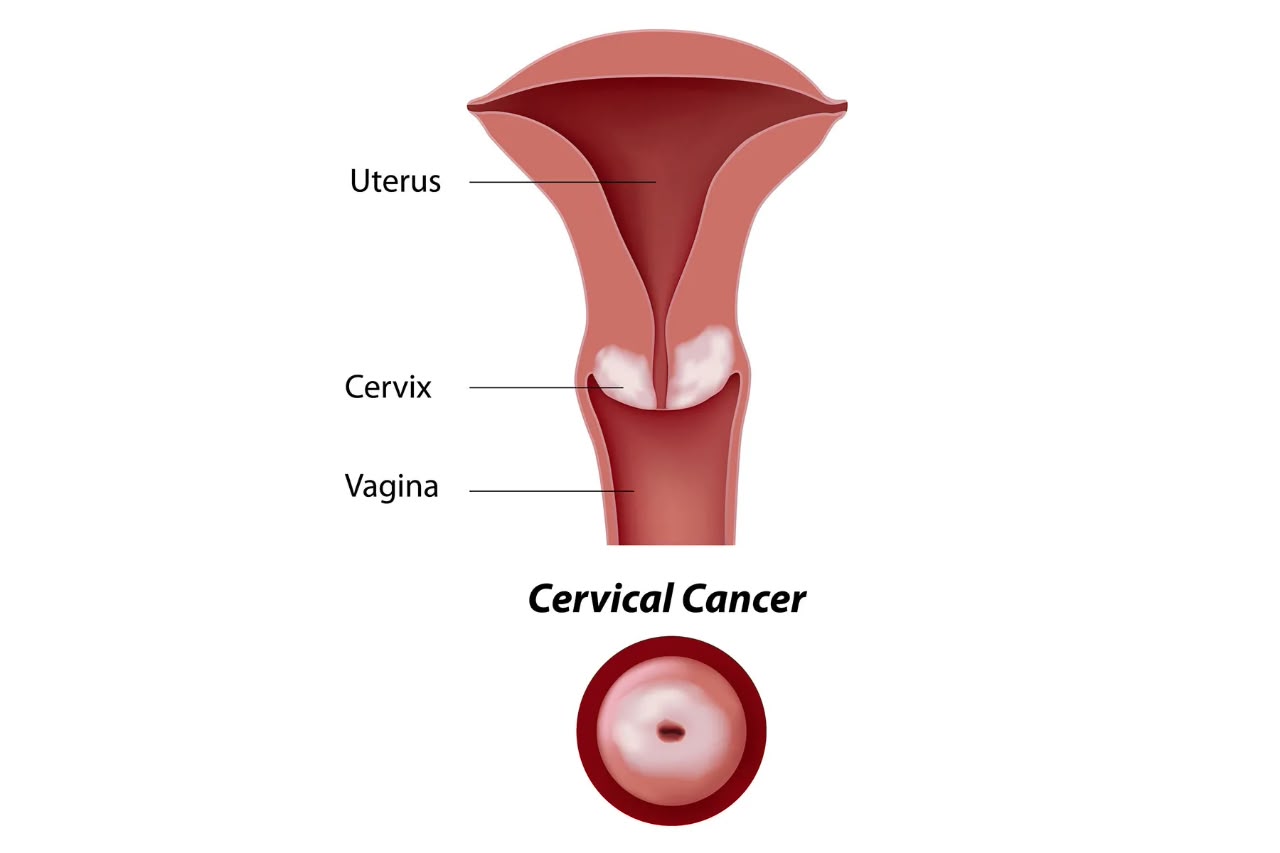 Cervical Cancer 